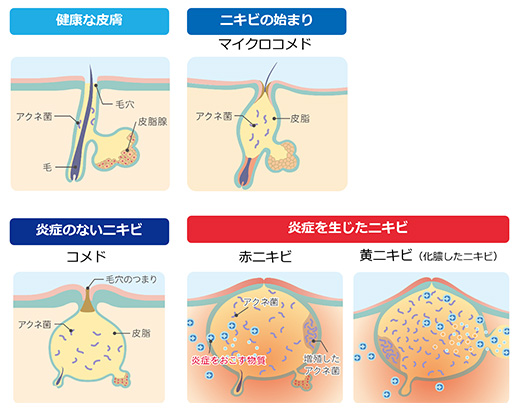 ニキビの原因