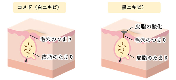 コメド（白ニキビ）