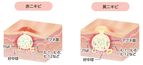 炎症性皮疹（赤ニキビ）