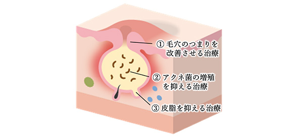 ニキビ治療の経過