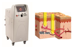 Vビームの機械と治療イメージ