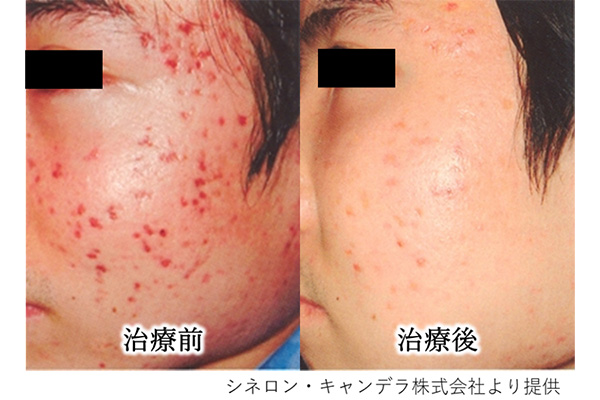 ニキビ、ニキビ跡の赤み