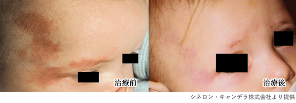 赤あざ（毛細血管奇形、単純性血管腫）